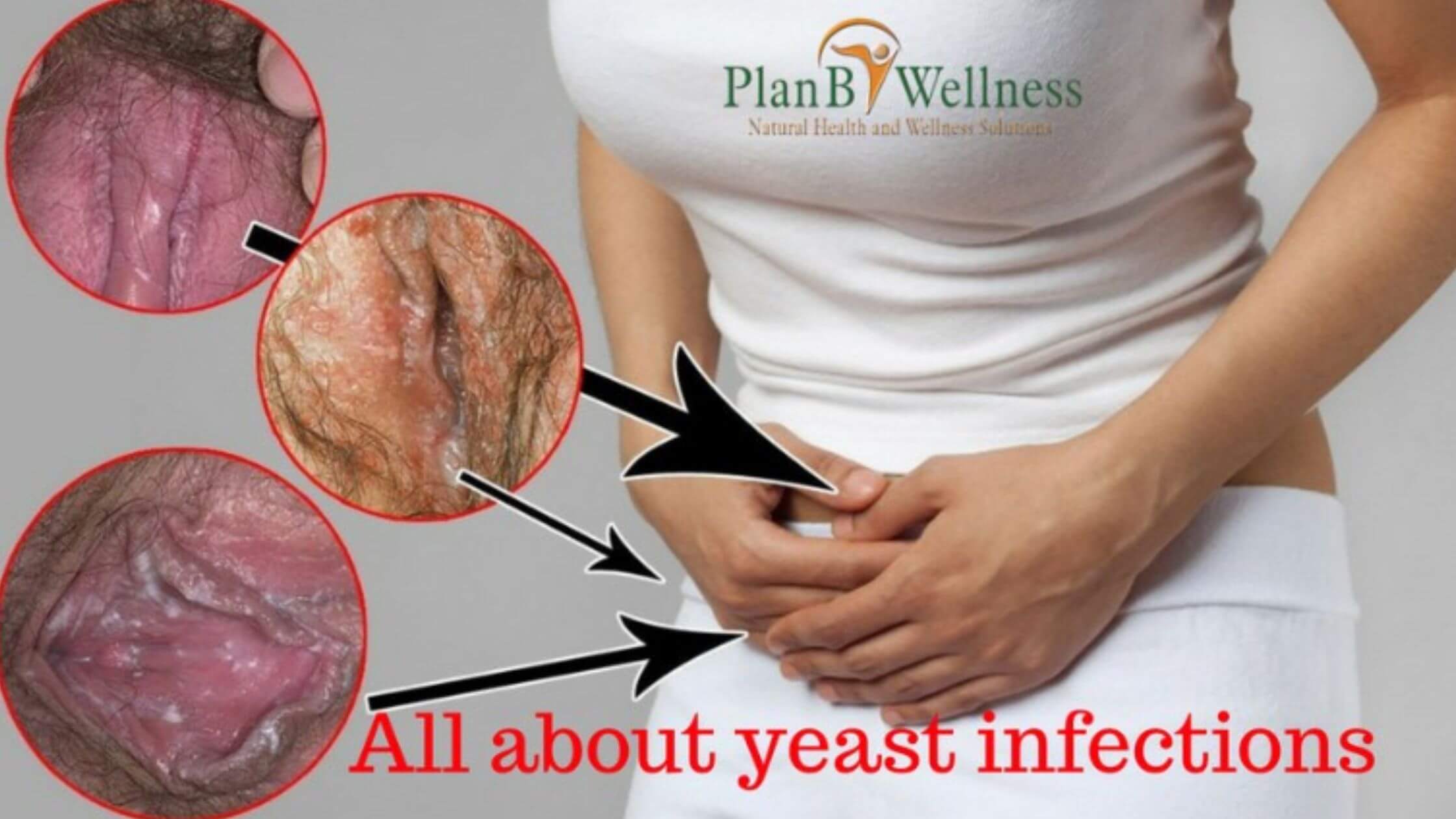 yeast infection