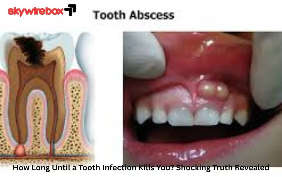 Long Until a Tooth Infection Kills You